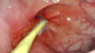 EXTREME ANAL SELF PERSPECTIVE. WEB-CAM INSIDE HER ANUS AS I POUND HER WITH MY GIGANTIC PENIS AND JIZZ DEEP INSIDE